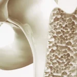 Sufres de osteoporosis: el tratamiento que realmente detiene la pérdida de calcio